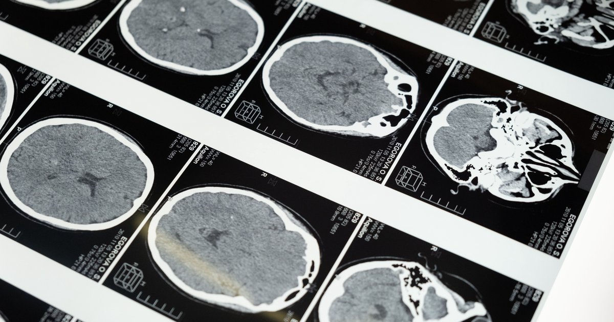 Silny stres: objawy neurologiczne
