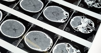 Silny stres: objawy neurologiczne